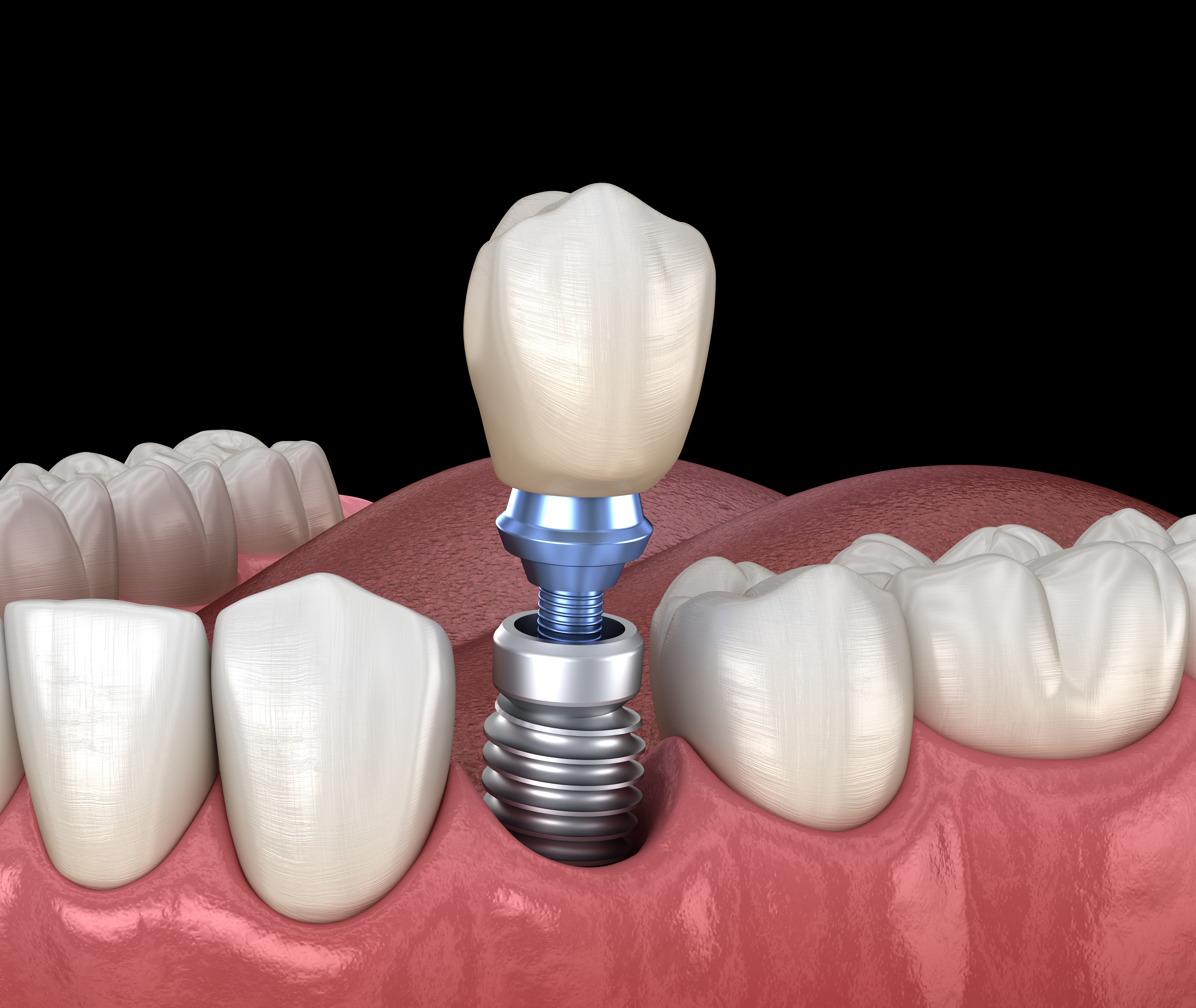 Implantate